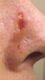 Rosacea Makeup on Deep Scab Scar   Pic Included   Scar   Red Mark Treatments   Forums