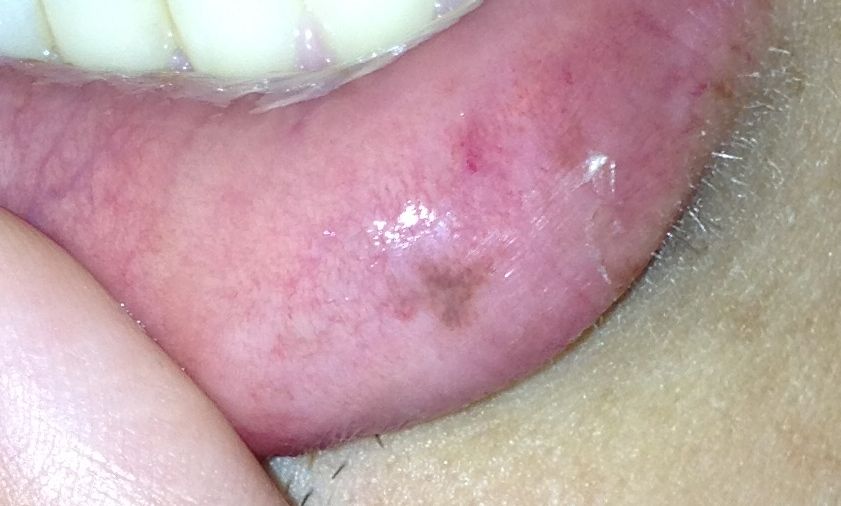sudden dark spots on lips - Dermatology - MedHelp